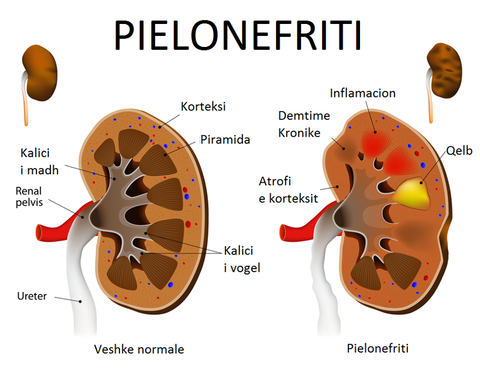 Pielonefriti