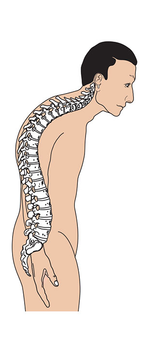 Skolioza (Deformimi I Shtyllës Kurrizore)