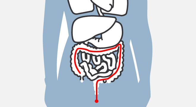 Sëmundja Crohn (Sindroma E Zorrës Së Inflamuar)