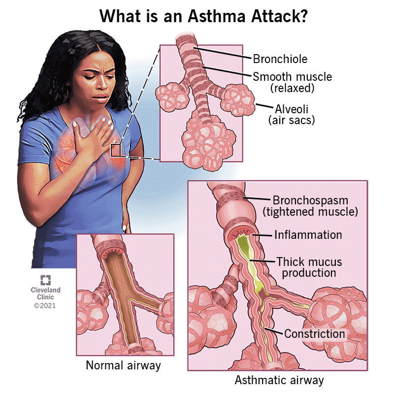 Astma (Asthma)