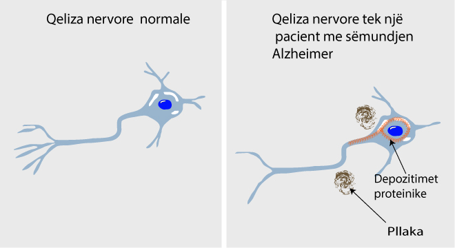 Demenca Senile (Demenca, Ulja E Aftësive Të Trurit Nga Pleqëria)