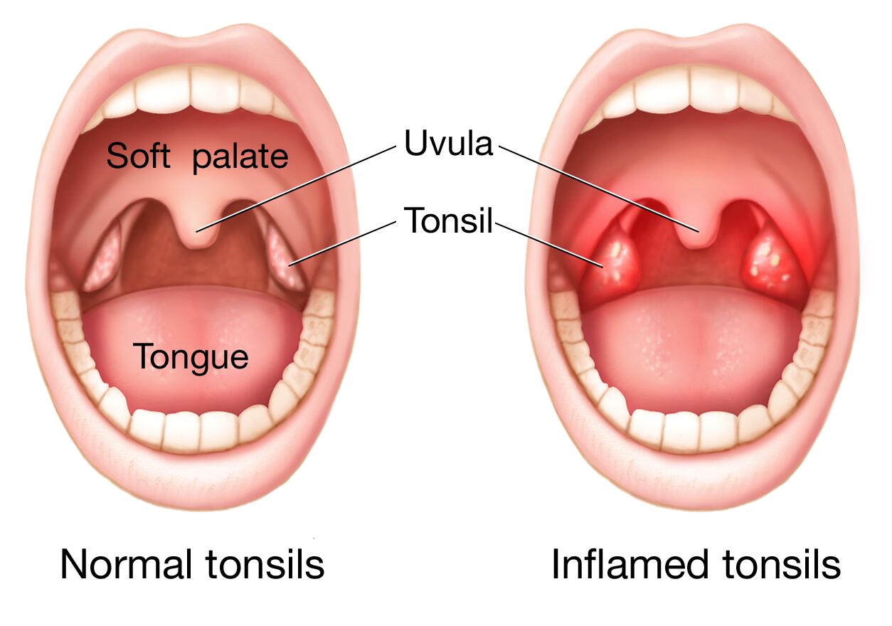 Inflamacioni I Bajameve (Amigdaliti, Angina, Tonsiliti)