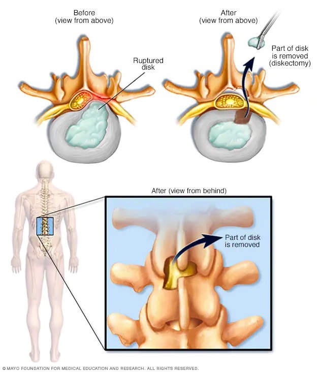 Trajtimi Fizioterapeutik Për Hernien Diskale: Çfarë Duhet Të Dini