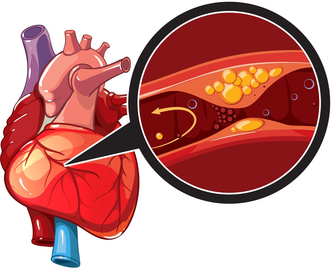 Çfarë duhet të dimë për sëmundjen e arterieve koronare cover images