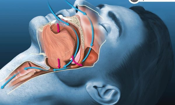 Sindroma E Apnesë Së Gjumit