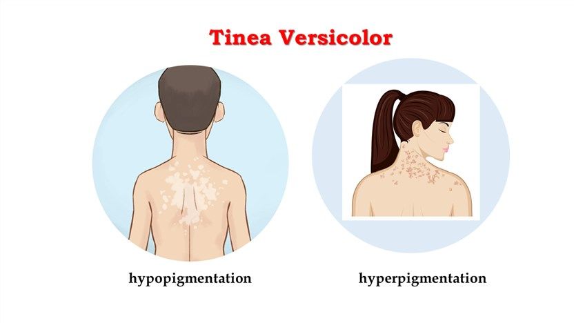 Pitiriazis (verzikolor Dhe Alba)
