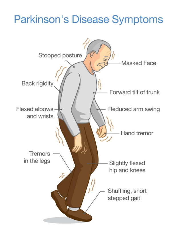 Shenjat e hershme dhe shkaqet e sëmundjes së Parkinsonit cover images