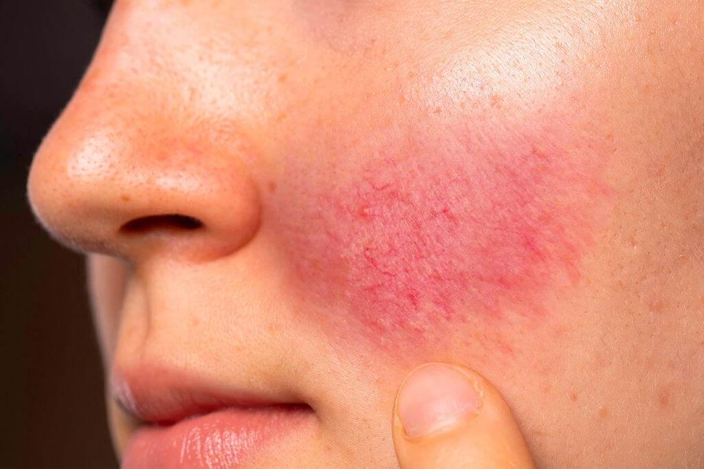 Rosacea (Akne Rosacea)